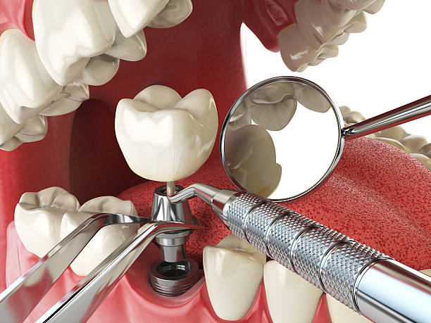 Best Emergency Tooth Extraction in Stinnett, TX